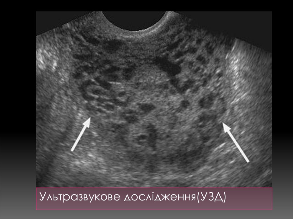 Эндометрия 3 мм. Трофобластическая болезнь УЗИ. Плодное яйцо трансабдоминально. Трофобластическая опухоль мрт.