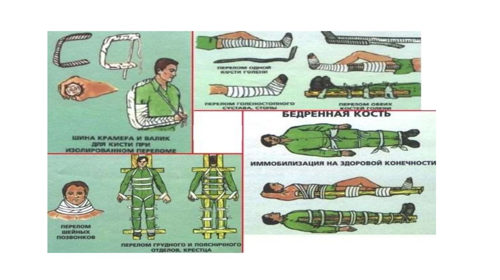 Страховка перелом ноги. Первая помощь при переломах конечностей. Массаж при переломах конечностей. Иммобилизация при повреждении позвоночника. Средства иммобилизации при переломах конечностей у кошки.