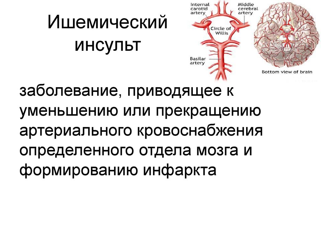Что такое ишемический инсульт головного мозга. Поражения головного мозга при ишемическом инсульта. Локализация ишемического инсульта. Мришемического и нсульта. Инсульт и ишемический инсульт.