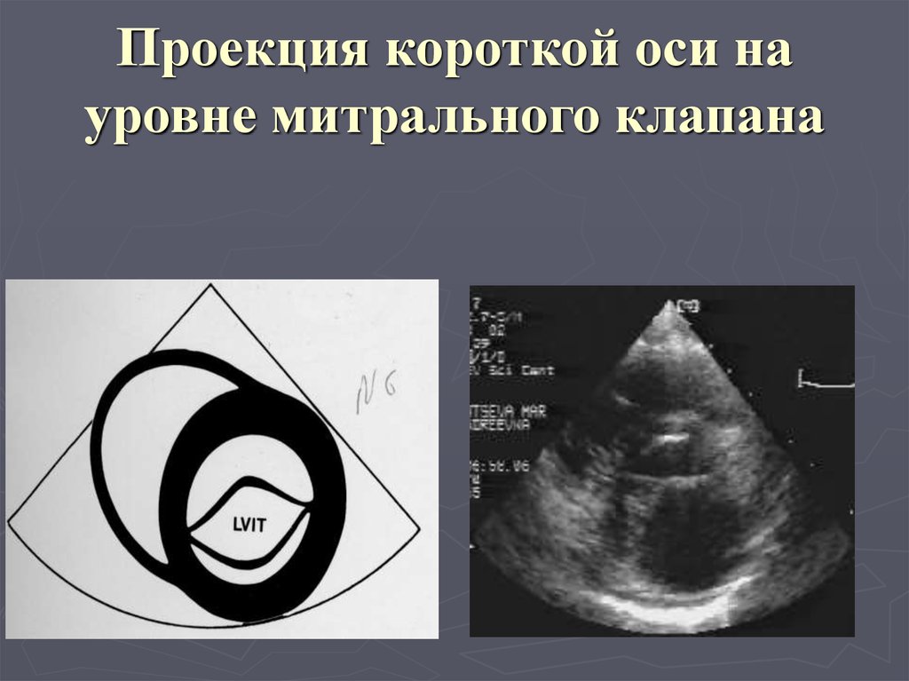 Ревматические болезни митрального клапана