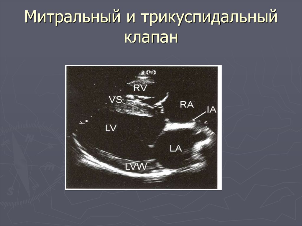 Дисплазия трикуспидального клапана. Трикуспидальная недостаточность эхокардиография. Створки трикуспидального клапана названия на ЭХОКГ. Образование на трикуспидальном клапане.