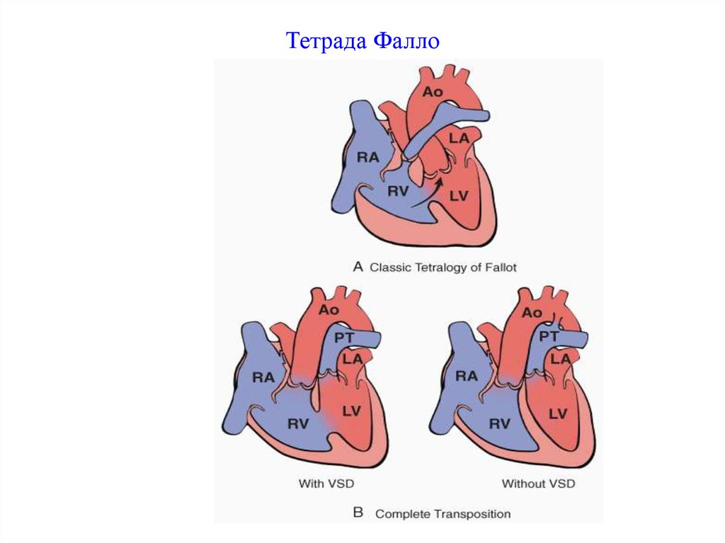 Тетрада фалло клинические