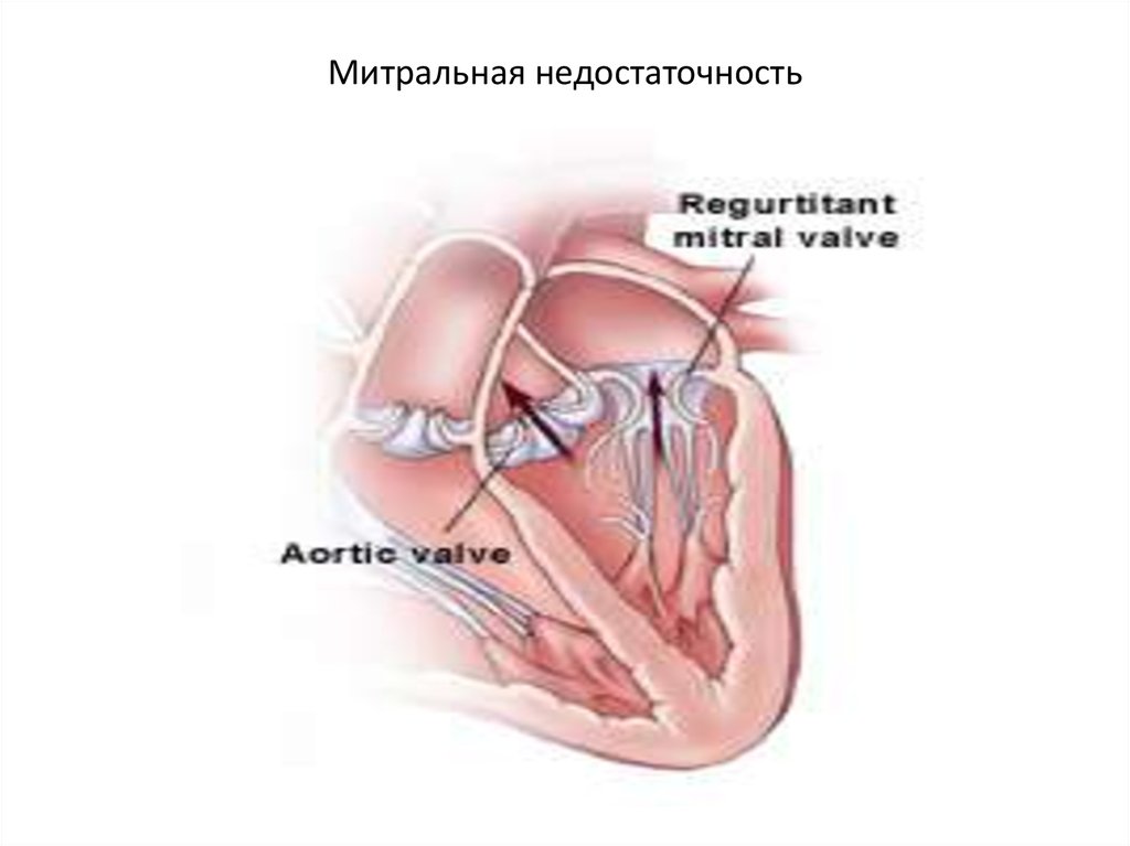 Недостаточность митрального клапана картинка