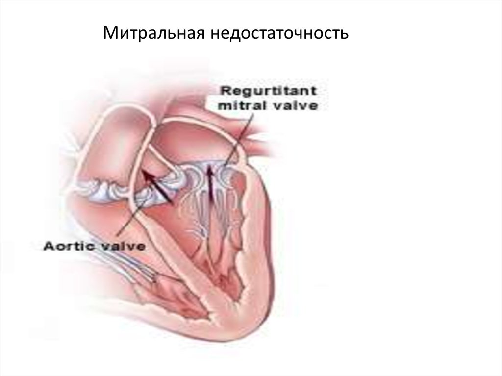 Сердечная недостаточность митрального клапана. Пороки сердца митральная недостаточность. Митральная недостаточность макропрепарат. Митральная недостаточность врожденный порок. Недостаточность митрального клапана мкб 10.