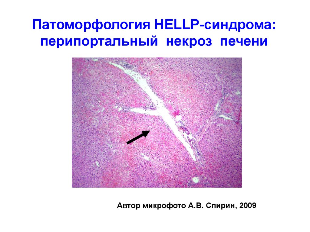 Некроз печени симптомы. Перипортальный некроз печени это. Перипортальный некрозы печени гистология. Перипортальный некроз гистология. Синдром некроза гепатоцитов.