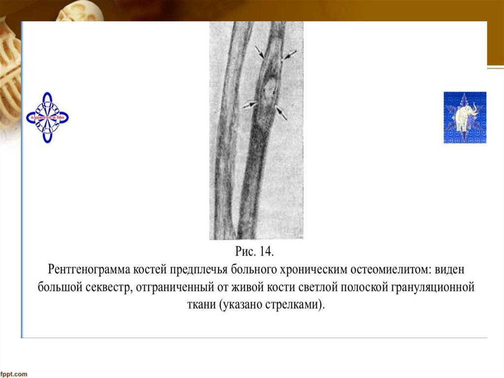 Рентгенодиагностика остеомиелита презентация