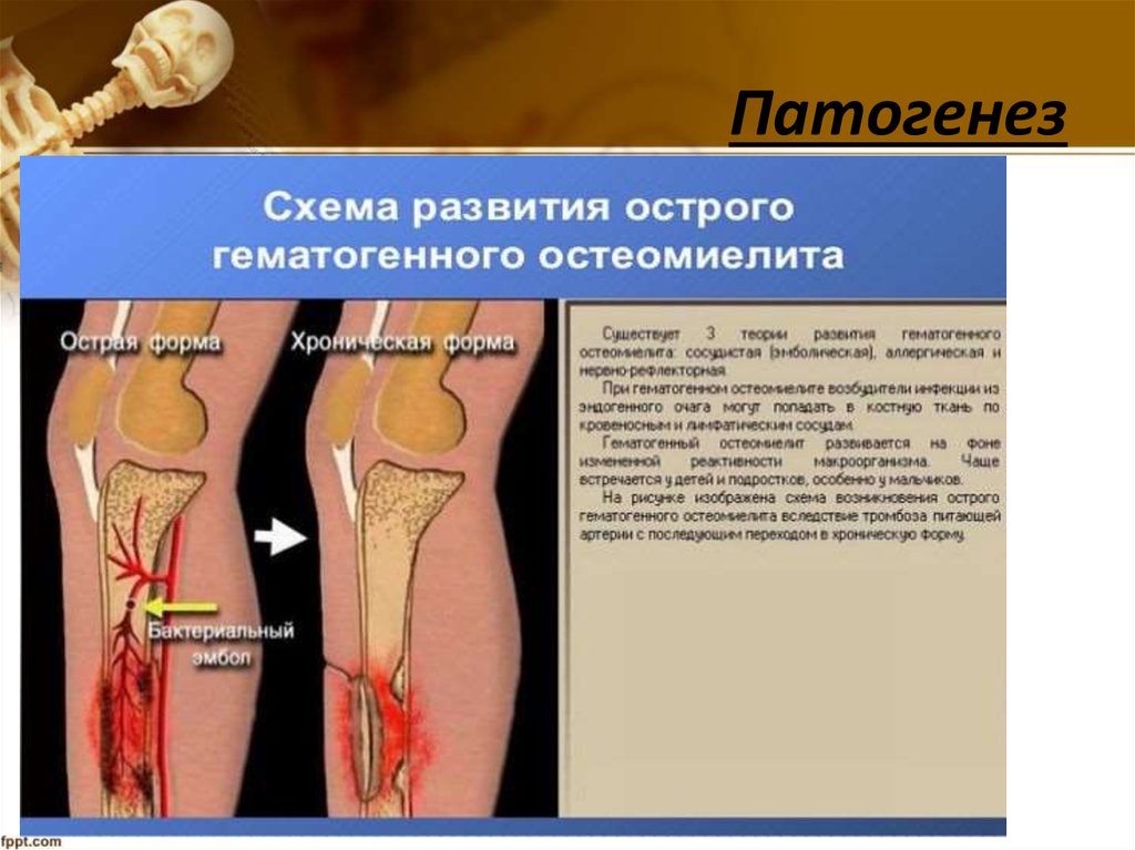 Практическое задание по теме Острый гематогенный остеомиелит нижней трети правой малоберцовой кости 