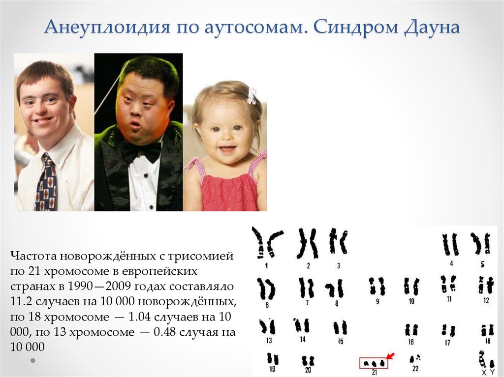 Набор дауна. Синдром Дауна анэуплоидия. Мозаичная трисомия хромосомы 8. Трисомия 21 21 хромосомы (анеуплоидия). Синдром Дауна аутосомы.