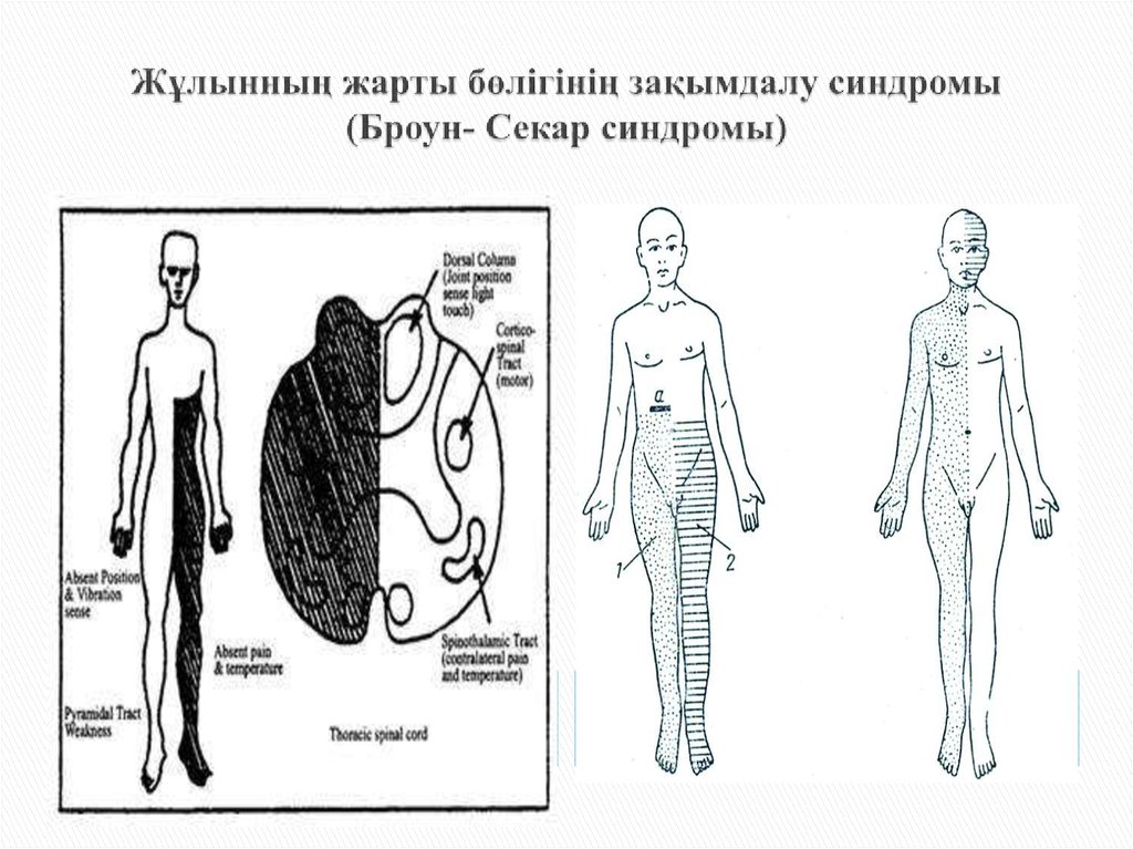 Синдром броун секара это. Следующие симптомы характерны для синдрома Броун-Секара:. Синдром Броун Секара неврология.