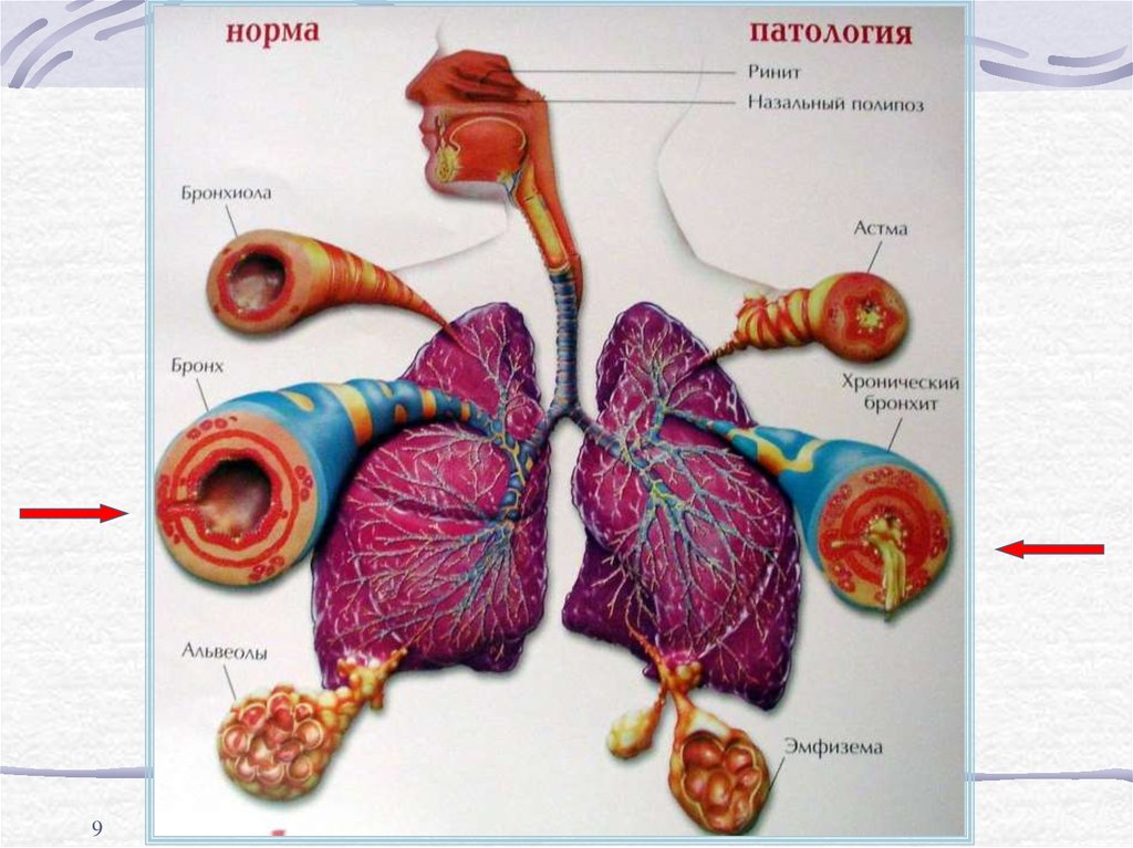 Бронхит на рисунке