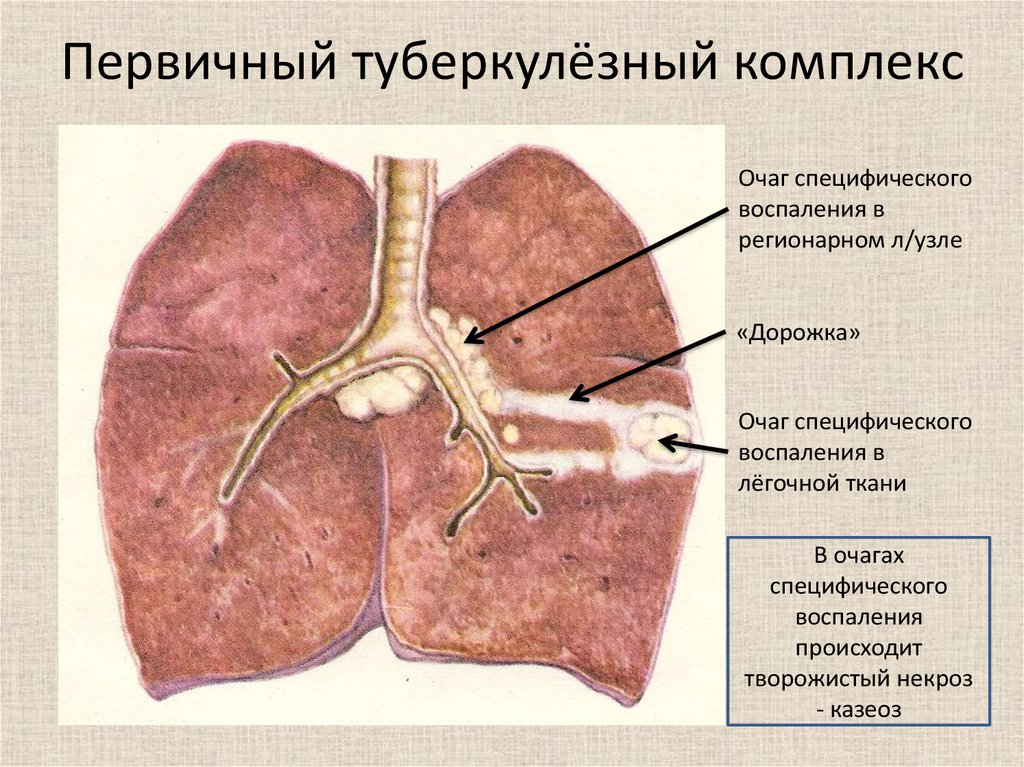 Туберкулезный комплекс. Обызвествленный первичный туберкулезный комплекс. Первичный туберкулиновый комплекс. Первичный туберкулезный комплекс фтизиатрия. Первичный туберкулезный комплекс это туберкулез.