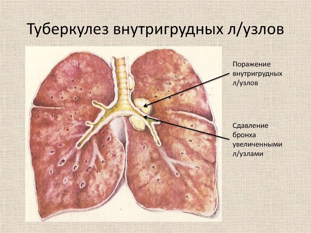 Легкие увеличен узел. Симптомы туберкулез лимфатических внутригрудных. Внутригрудные лимфатические узлы туберкулез. Туберкулёз лимфатических узлов у детей. Формы туберкулеза внутригрудных лимфатических узлов.