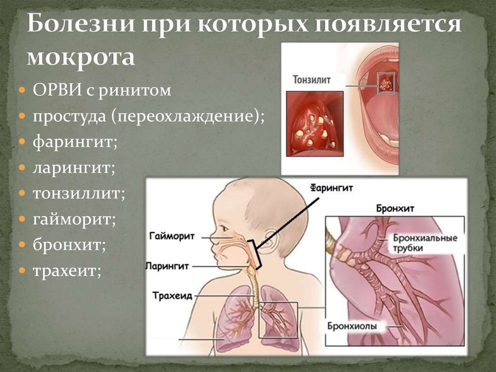 Болезни при которых появляется мокрота