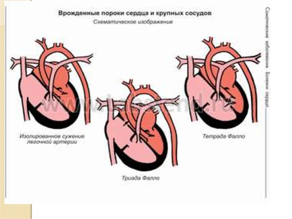 Пороки сердца у детей. Врожденные пороки развития сердца. Врожденные пороки сердца дефект. Врождённые пороки ердца. Вродденныепороки сердца.