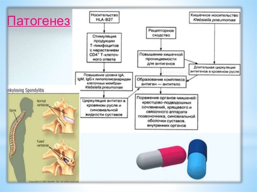Hla 27. Болезнь Бехтерева этиология. Схема патогенеза анкилозирующего спондилит. HLA-b27 и болезнь Бехтерева патогенез. HLA b27 болезнь Бехтерева.