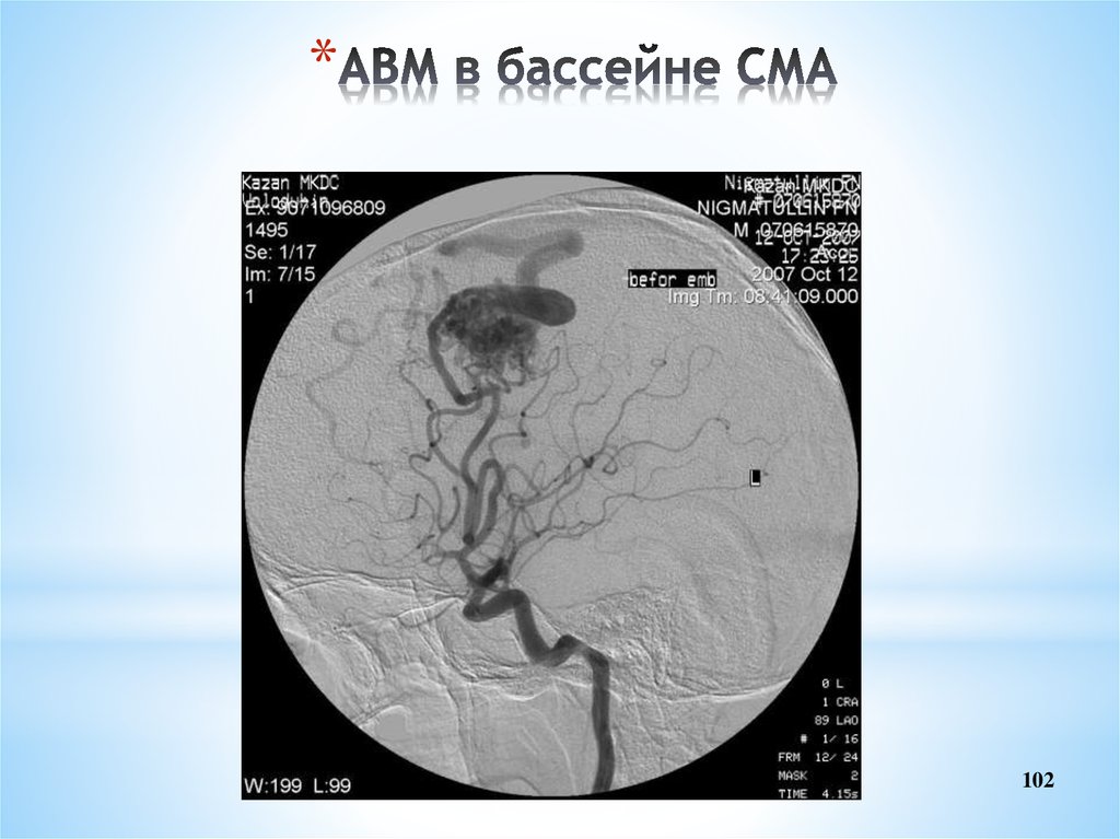 Инсульт в бассейне мозговой артерии. Бассейн средней мозговой артерии. Геморрагический инсульт в бассейне средней мозговой артерии. Инсульт в бассейне средней мозговой артерии клиника. Инсульт в бассейне СМА.