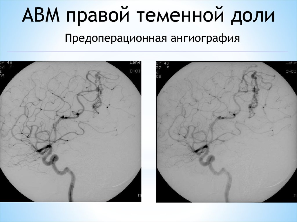 Геморрагический инсульт ангиография. Геморрагический инсульт микропрепарат.