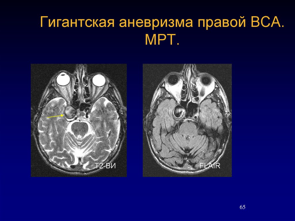 Мешотчатые аневризмы вса. Аневризма кавернозного сегмента ВСА мрт. Аневризма внутренней сонной артерии кт. Аневризма внутренней сонной артерии мрт. Мешотчатая аневризма внутренней сонной.