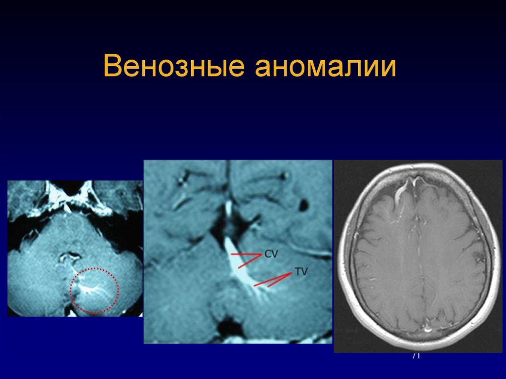 Гемисферы мозжечка изменение