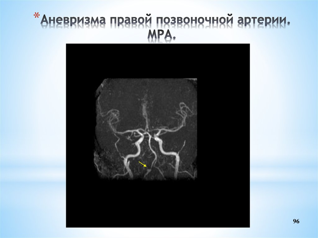 Гипоплазия правой артерии мозга. Гипоплазия позвоночной артерии мрт. Аневризма правой позвоночной артерии.