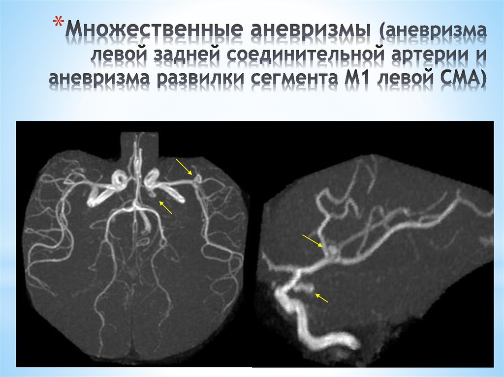 Левая средняя мозговая артерия инсульт