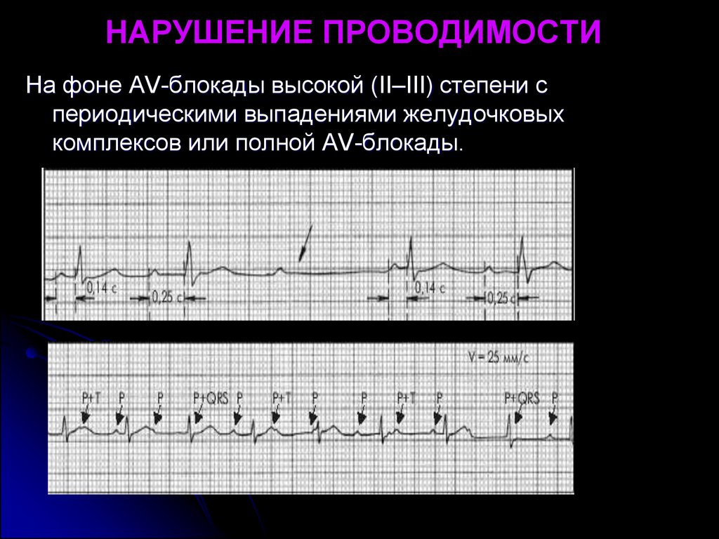 Что значит нарушение проводимости. Нарушение проводимости блокады. Нарушение проводимости уровни блокады. Патология проводимости виды блокад. Нарушения проводимости sa блокады.