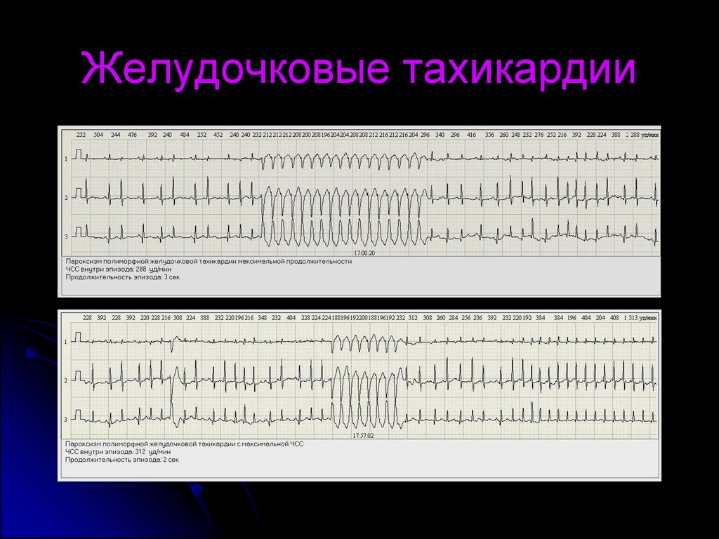 Фото желудочковая тахикардия