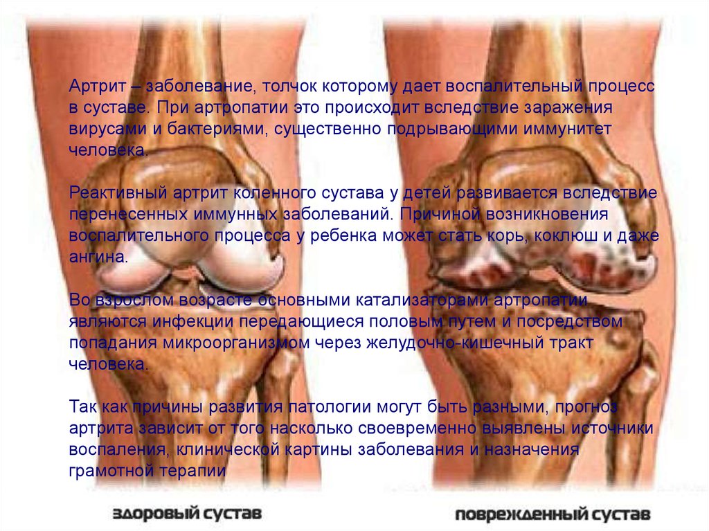 Артрит детский коленного сустава. Артрит коленного сустава - симптомы и лечение Артрит коленного сустава: причины заболевания, её степени и симптомы Детский открытый регулируемый ортез коленного сустава Reh4Mat AM-DOSK-O.