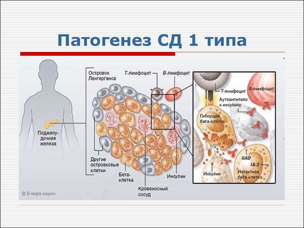 Типа патогенез. Этиология сд1. Патогенез СД 1 типа патогенез. Механизм развития СД 1 типа. Патогенез иммуноопосредованного СД 1 типа.