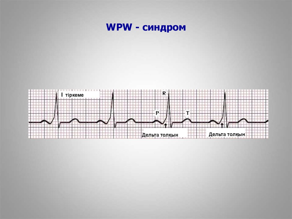 Wpw синдром экг