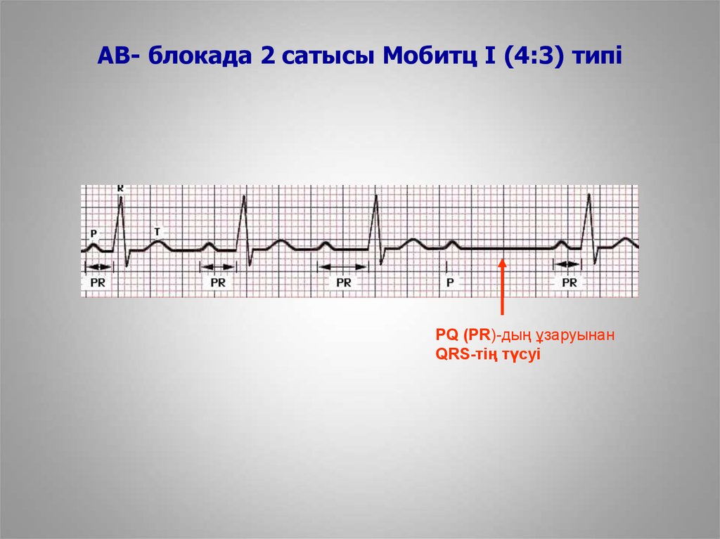 Ав блокада 1. АВ блокада Мобитц 3 на ЭКГ. Мобитц 1 и Мобитц 2. АV блокада 2 степени Мобитц. АВ блокада 2 ст Мобитц 2 ЭКГ критерии.