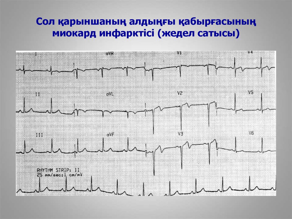 Миокард инфарктісі презентация