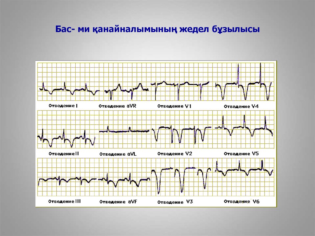 Гиперкалиемия на экг картинки