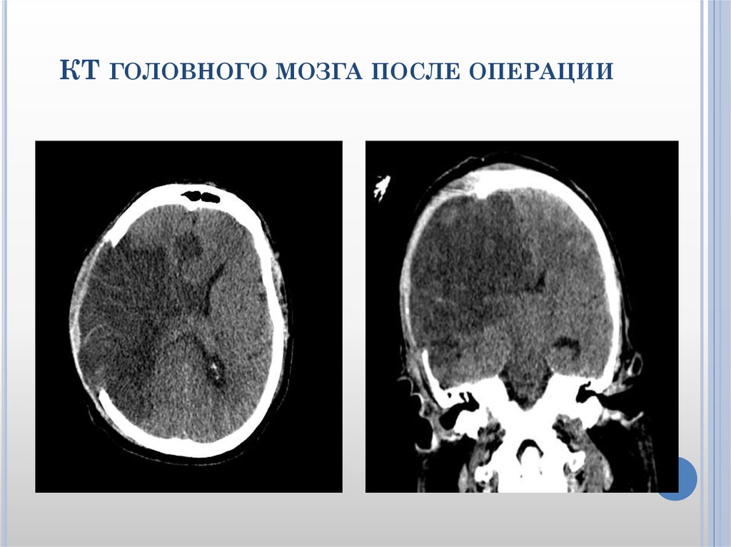 После мозгового. Нейровизуализация головного мозга. Нейровизуализация компьютерная томография. Кровообращение головного мозга на кт. Послеоперационные изменения головного мозга кт.