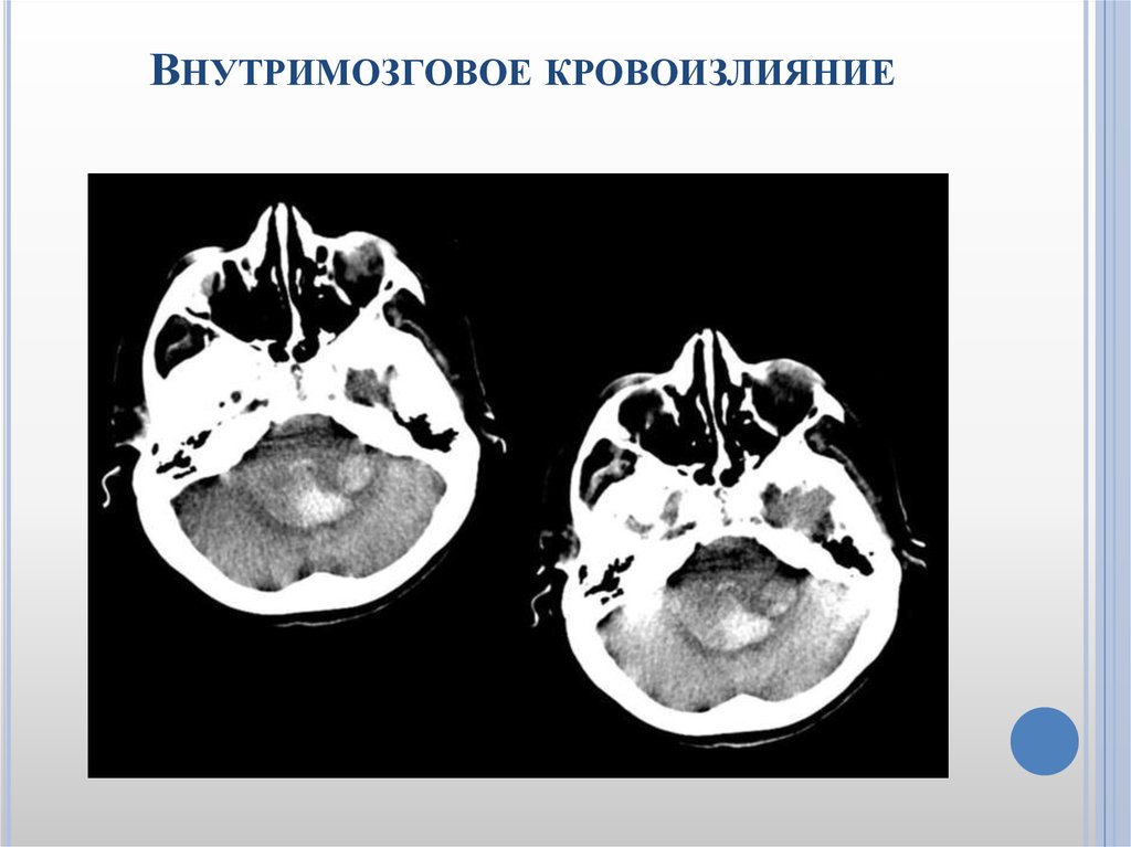 Острое нарушение мозгового кровообращения карта вызова смп