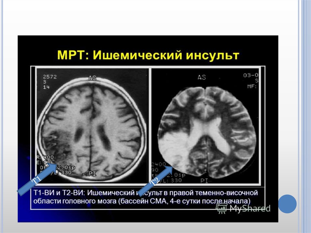 Левая средняя мозговая артерия инсульт. Ишемический инсульт снимок кт. Мрт снимки ишемического инсульта.
