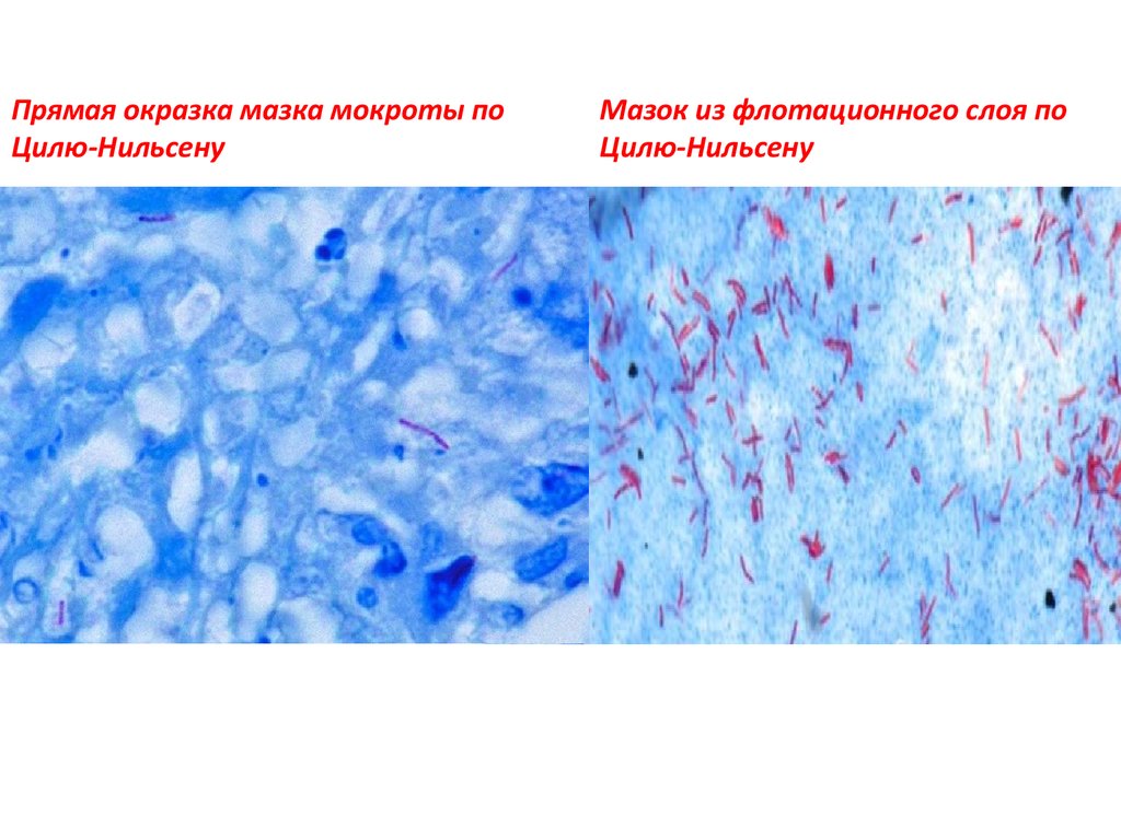 Мокрота на микобактерии. Mycobacterium tuberculosis окраска по Цилю-Нильсену. Микроскопия по Цилю-Нильсену. Кислотоустойчивые бактерии в мокроте – окраска по Цилю-Нильсену. Окраска кислотоустойчивых микобактерий по Цилю-Нильсену.