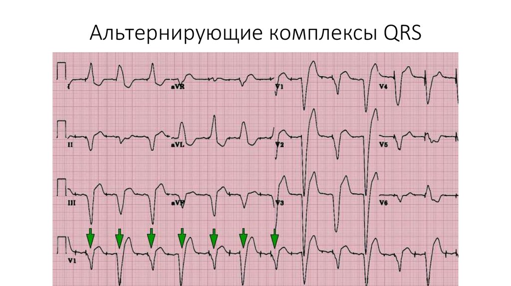 Схема альтернирующего пульса основные характеристики