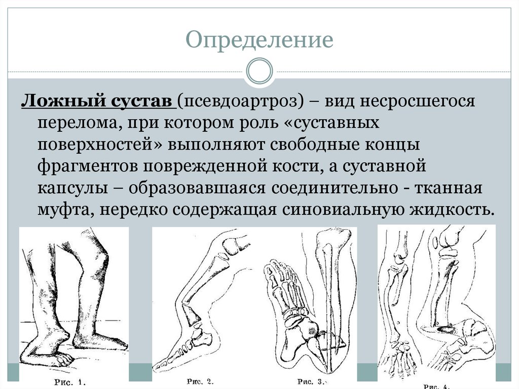 Ложный сустав рисунок