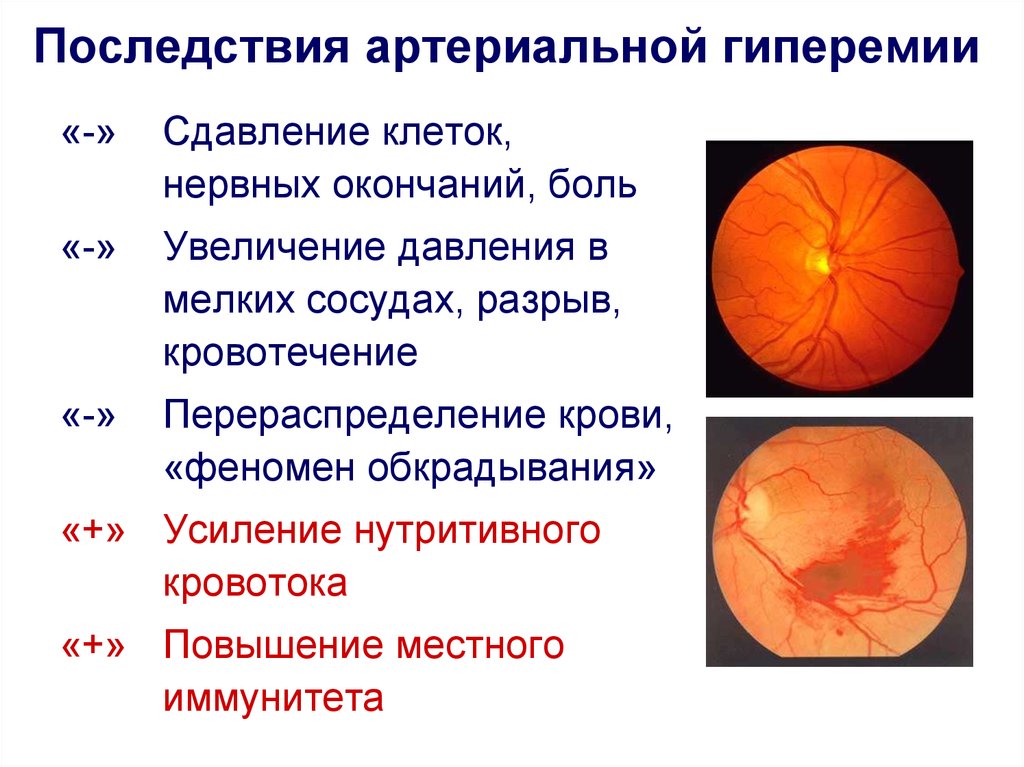 Артериальная гиперемия воспаление. Последствия артериальной гиперемии. Осложнения артериальной гиперемии. Физиологическая артериальная гиперемия. Патологическая артериальная гиперемия.