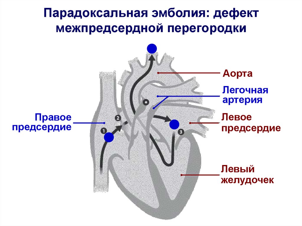 Направление движения эмболов рисунок