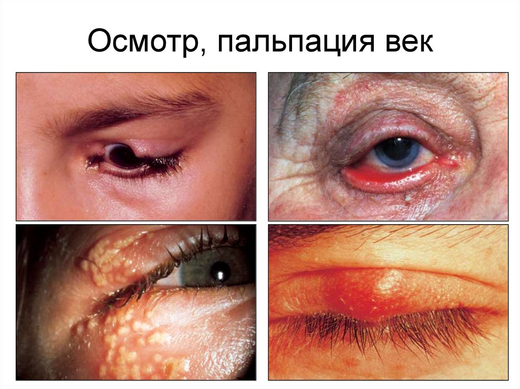 Осмотр, пальпация век