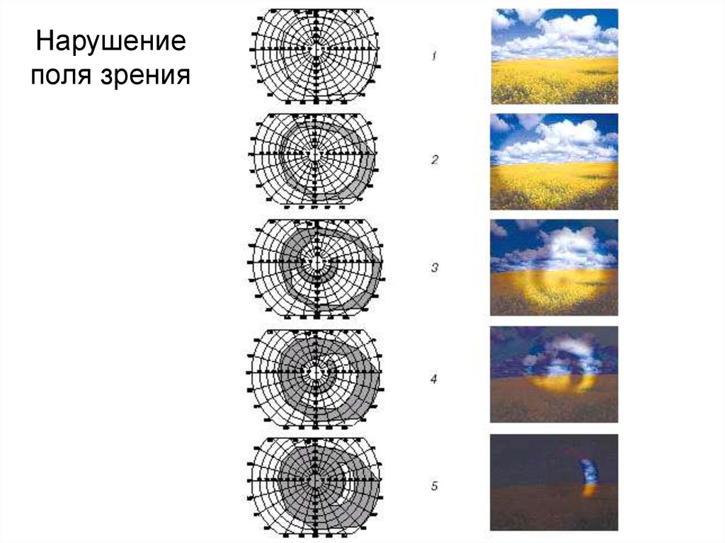 Поля зрения схема бланк