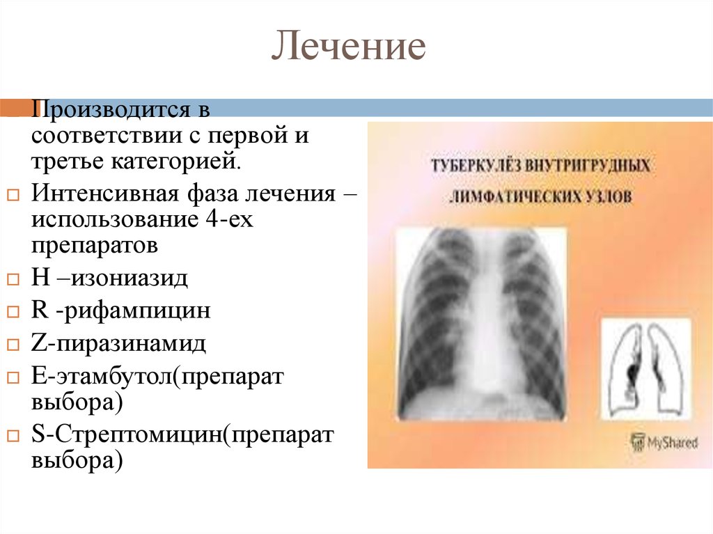 Туберкулез внутригрудных лимфатических узлов презентация