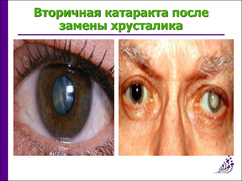 Вторичная катаракта после операции. Причины вторичной катаракты. ИОЛ вторичная катаракта. Дисцизия вторичной катаракты.