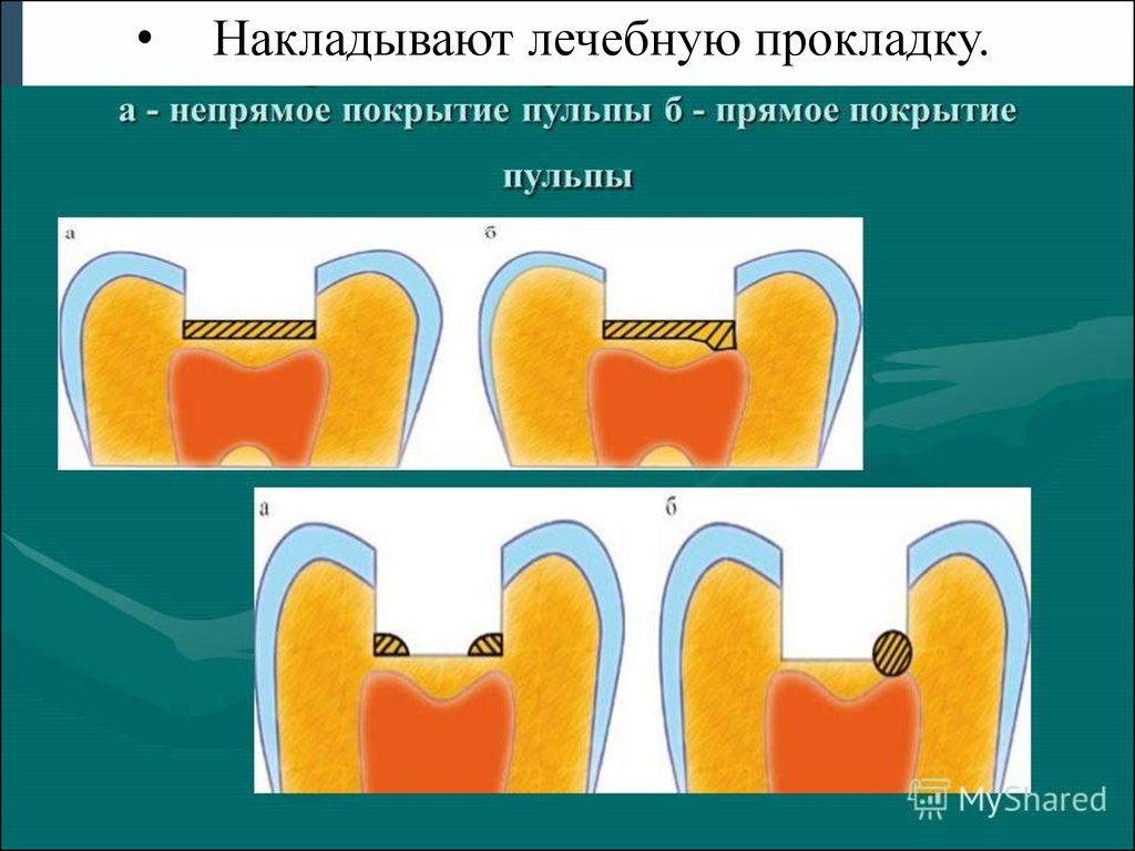 Схема наложения лечебных прокладок