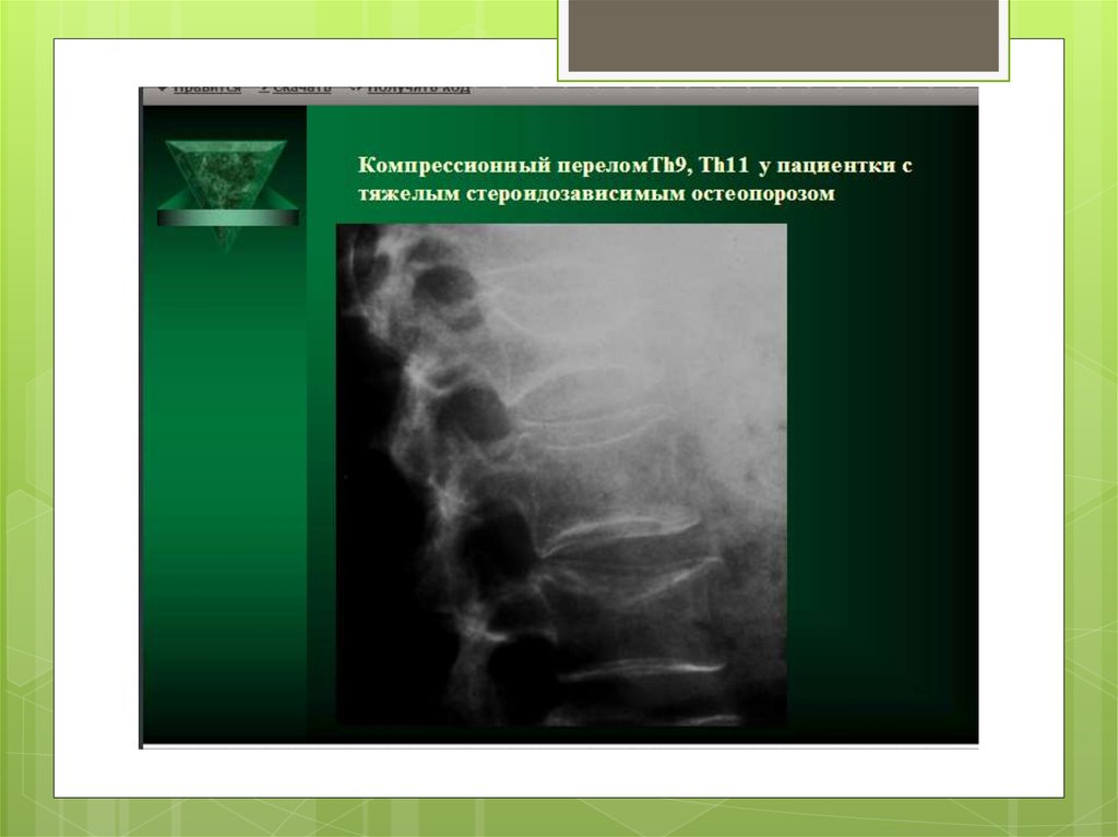 Компрессионный перелом это. Компрессионный перелом th11 позвонка. Перелом тела th9 позвонка. Перелом тела th11 позвонка. Компрессионный перелом позвонков th10, th11.