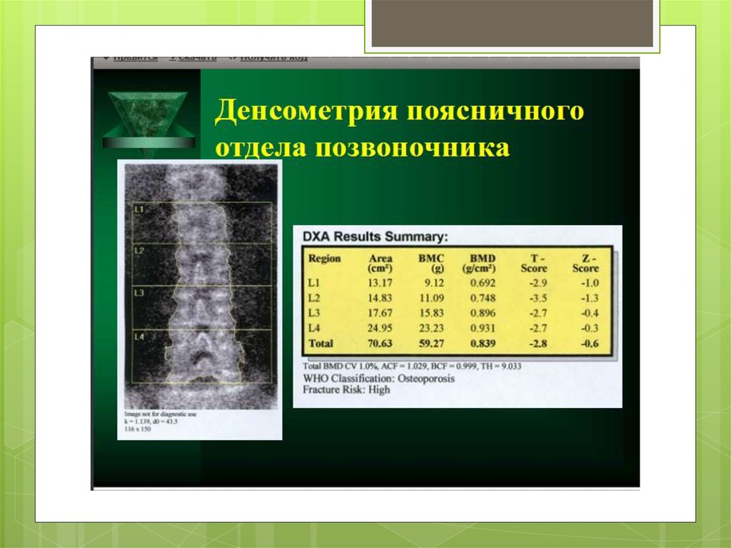 Норма костей. Денситометрия поясничного отдела остеопороз. Денситометрия позвоночника т-критерий -2.8 SD. Денситометрии поясничного отдела позвоночника т критерий. Показатель плотности костей.