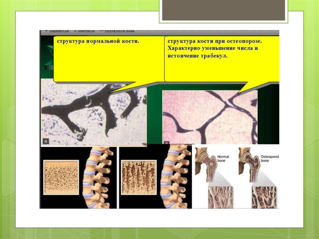 Изменение структуры кости. Структура костной ткани остеопороз. Структура кости при остеопорозе. Что такое структура костей остеопороз на.