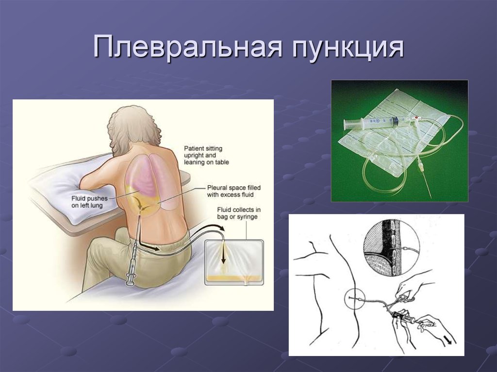 Плевральная пункция рисунок